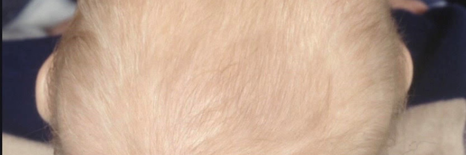 Skævt kranie hos baby