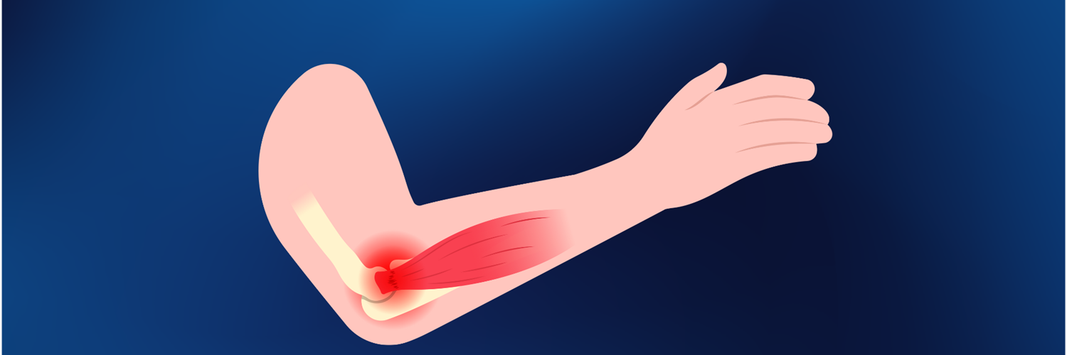 Hvad er en tennisalbue og hvordan behandles den?